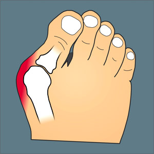 Hallux_valgus